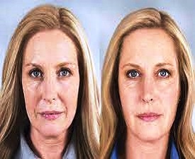 Differences between Botox and Juvederm 